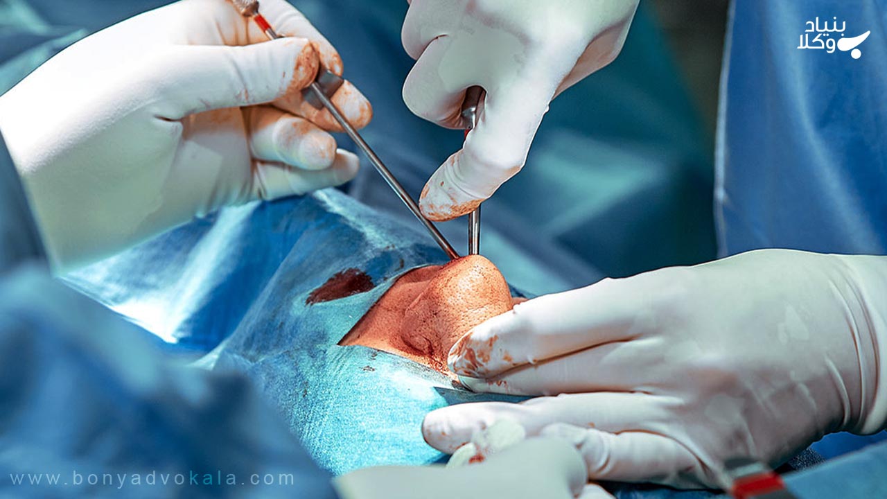 دیه شکستگی بینی در سال ۱۴۰۲ 4 دیه شکستگی بینی جراحی