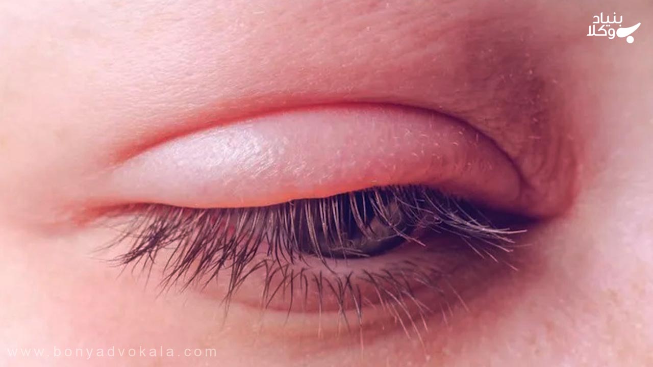از بین بردن پلک و چشم
