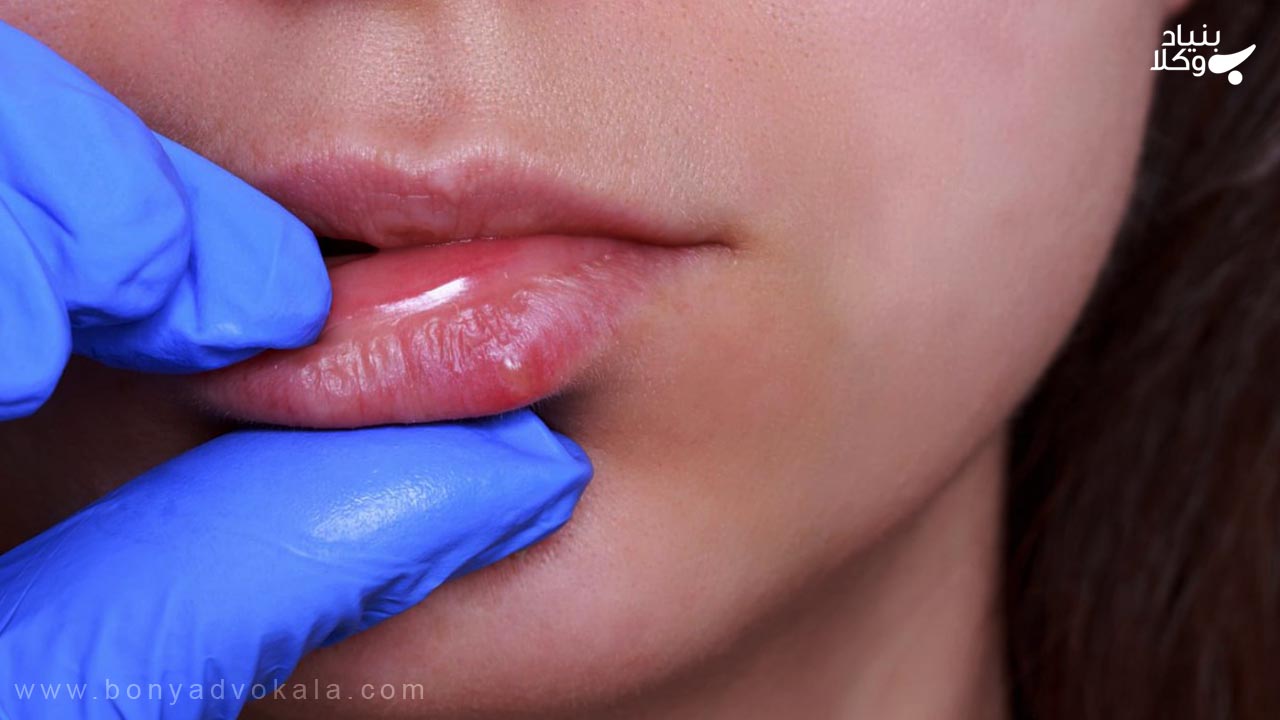 محکومیت دیه از بین بردن و فلج شدن لب