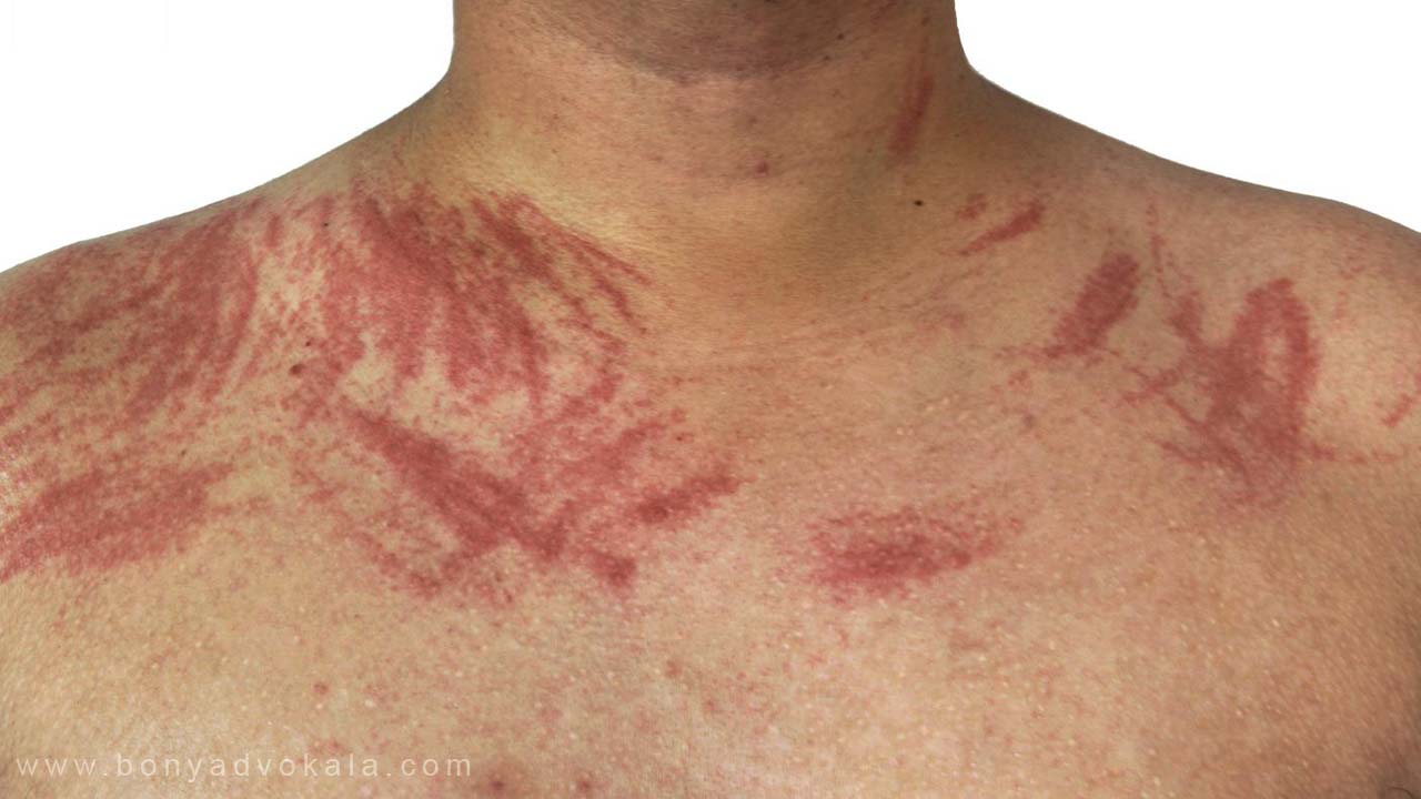 دیه خراشیدگی صورت و بدن 4 دیه خراشیدگی پوست