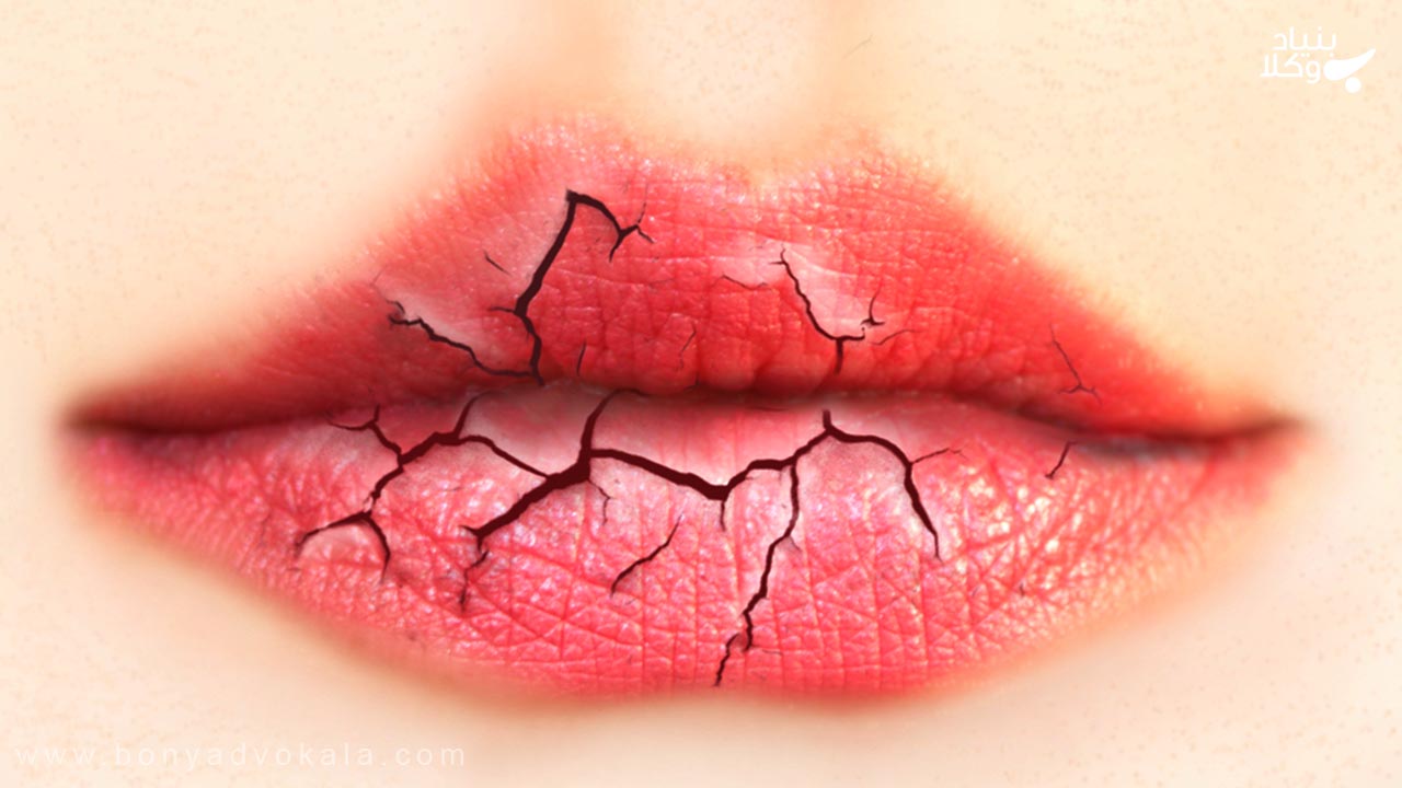 دیه پارگی لب