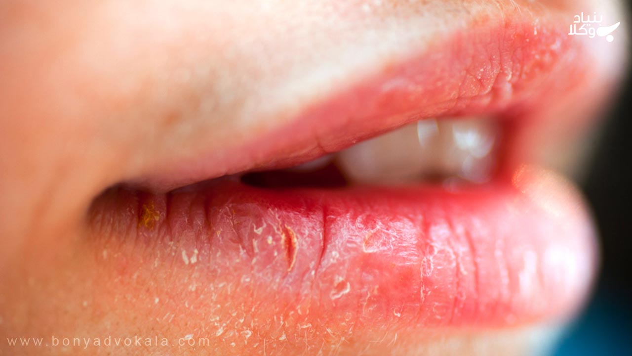 پارگی لب ها