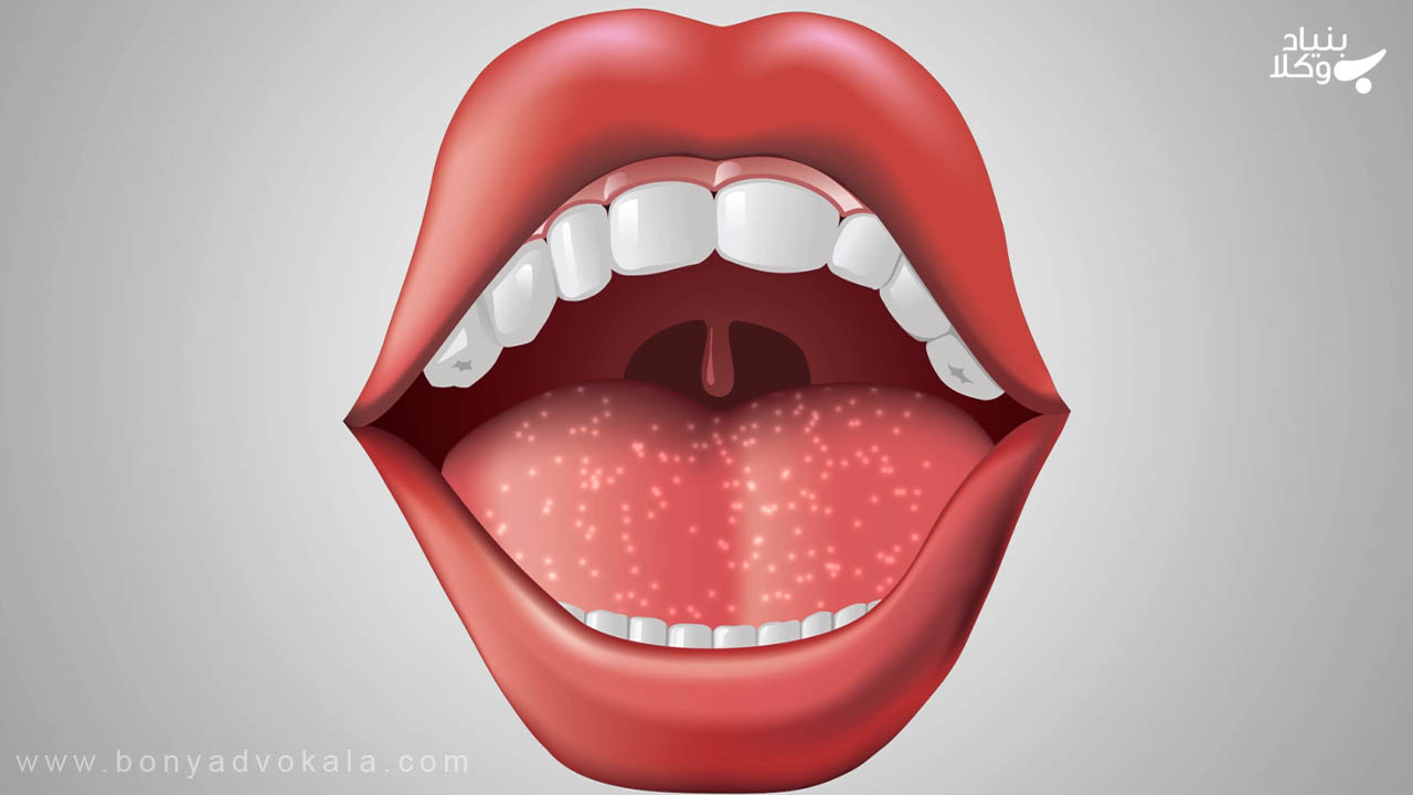 دیه زبان 3 قطع شدن کامل زبان