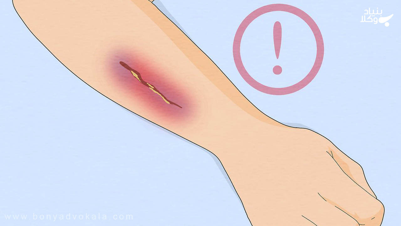 جنایت مادون نفس