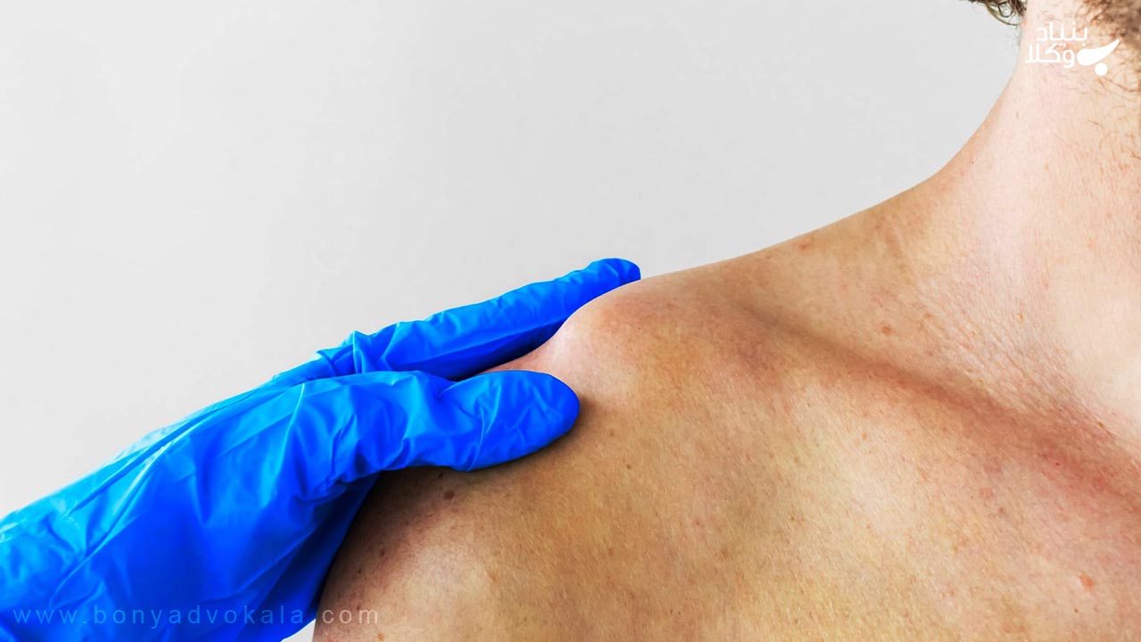 دیه قطع کردن استخوان ترقوه