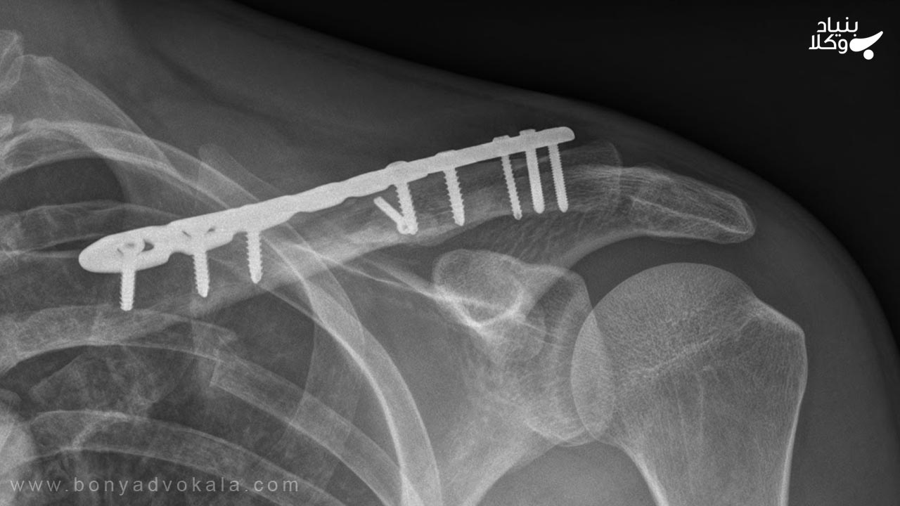 دیه ترک خوردن استخوان ترقوه