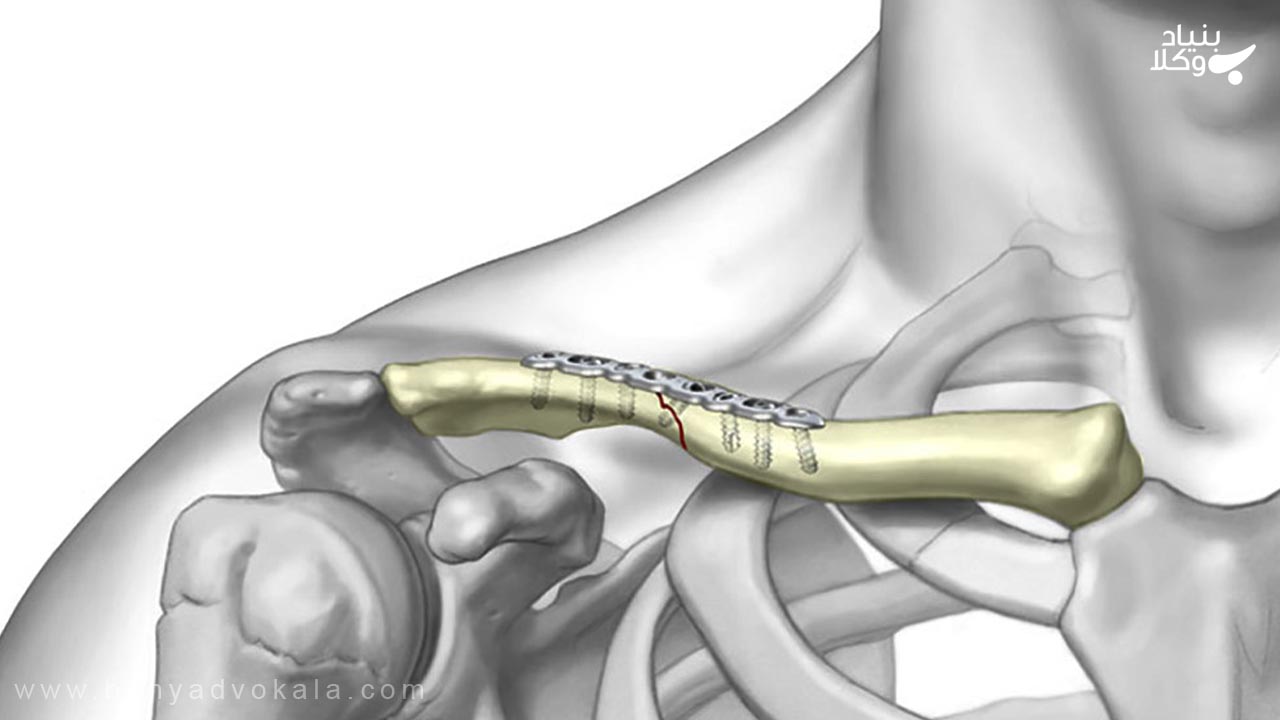 دیه شکستگی استخوان ترقوه در ماه حرام
