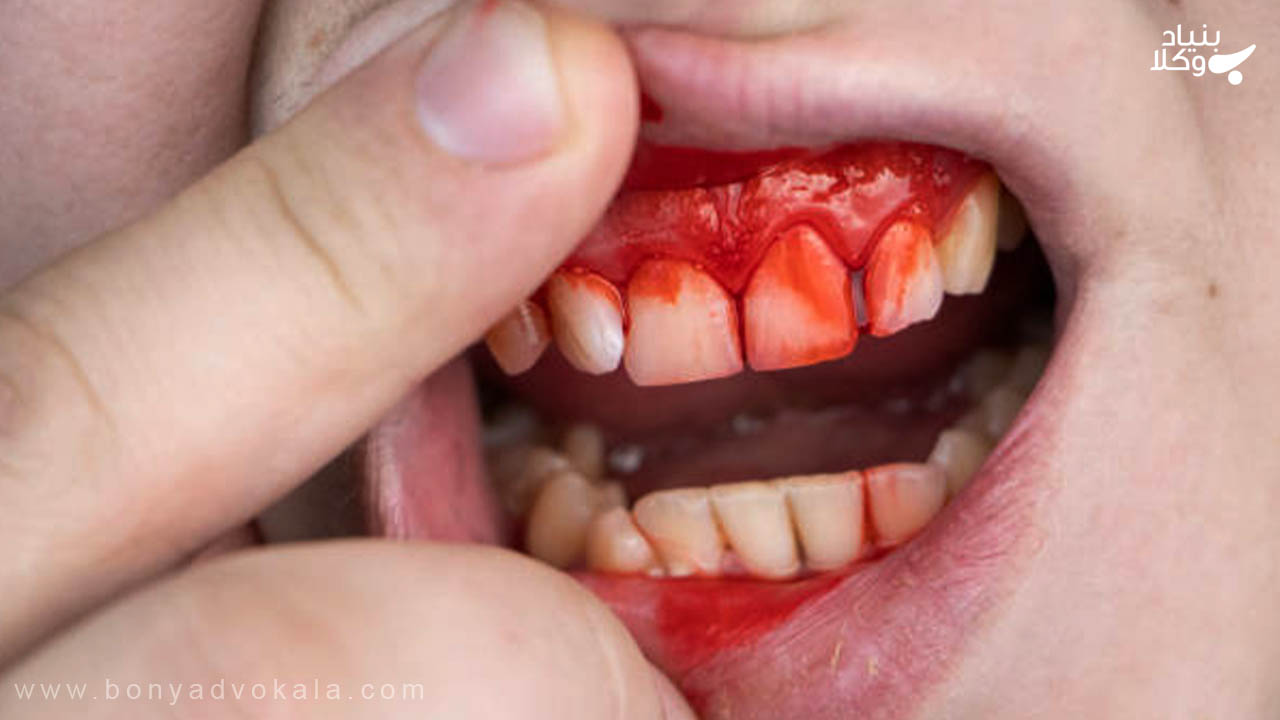 دیه دندان شکسته