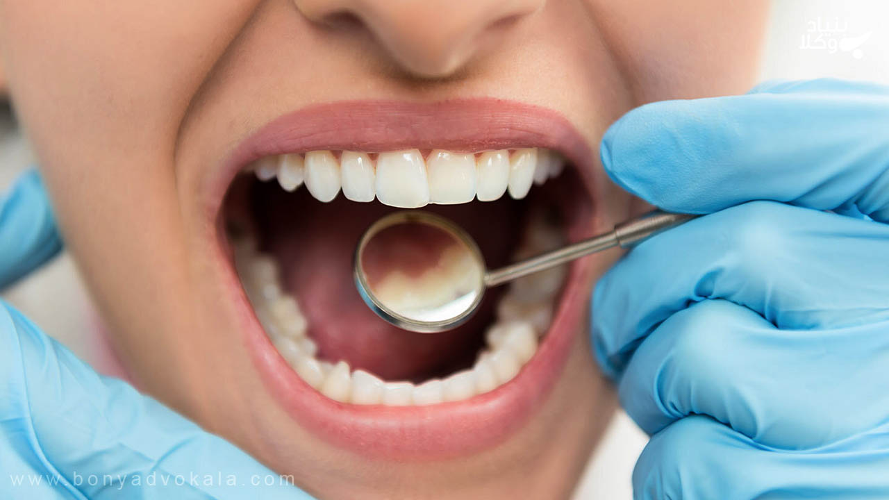 دیه تمام دندان ها