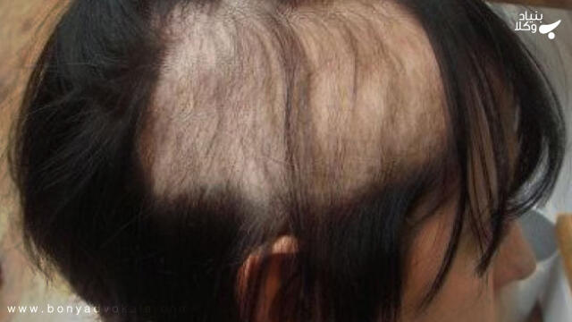 دیه کندن مو زن چقدر است؟